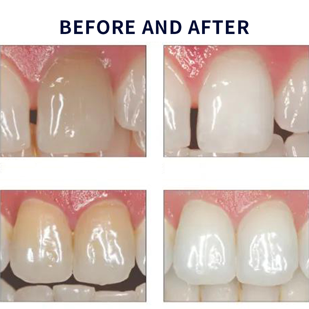 Opalescence beyazlatma 20% PF  - Teeth Whitening At Home Kit incelemesi ve fiyatı