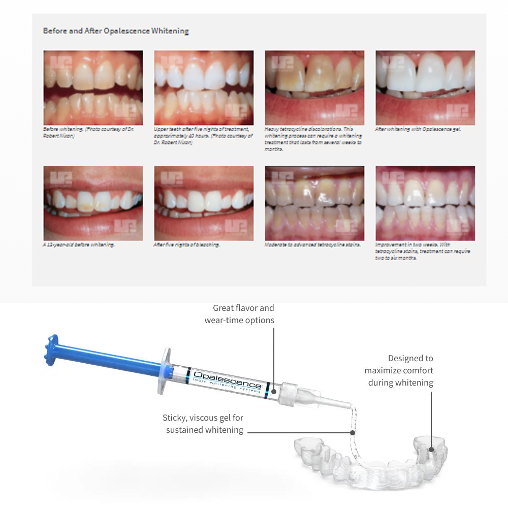 Opalescence beyazlatma 20% PF  - Teeth Whitening At Home Kit incelemesi ve fiyatı