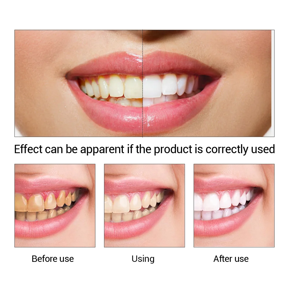 FTEENPLY diş beyazlatma özü to - Teeth Whitening Best incelemesi ve fiyatı