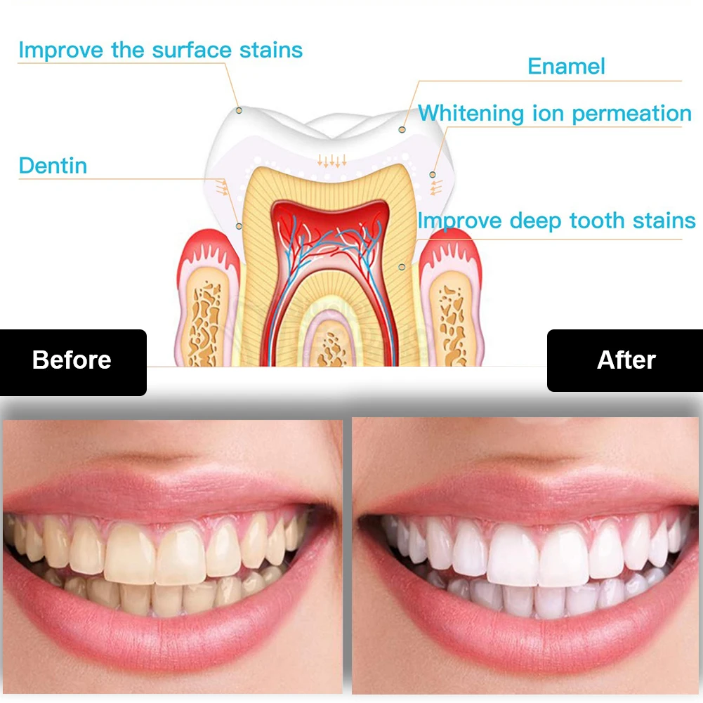 Diş Diş Beyazlatma Kiti Mini 1 - Teeth Whitening Foam incelemesi ve fiyatı